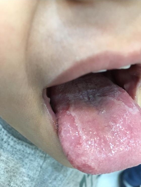 (Geographic Tongue) 
