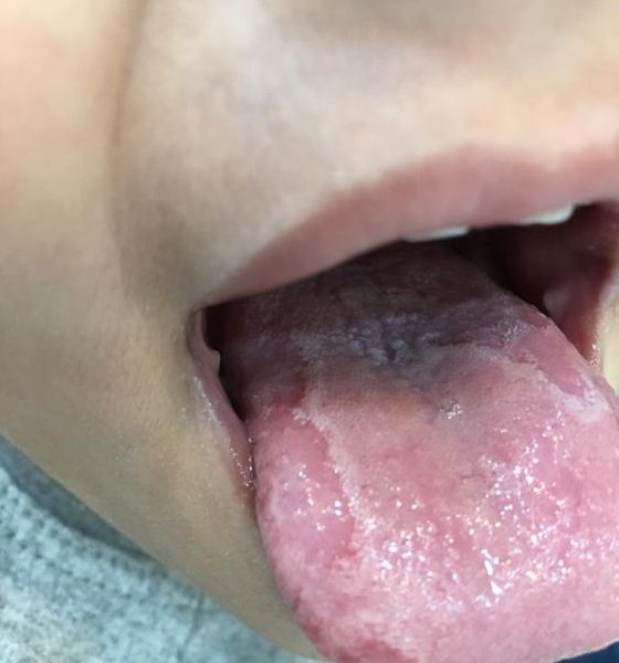 (Geographic Tongue)